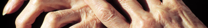 Arthritis